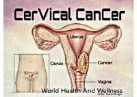 cervical cancer (1).pdf